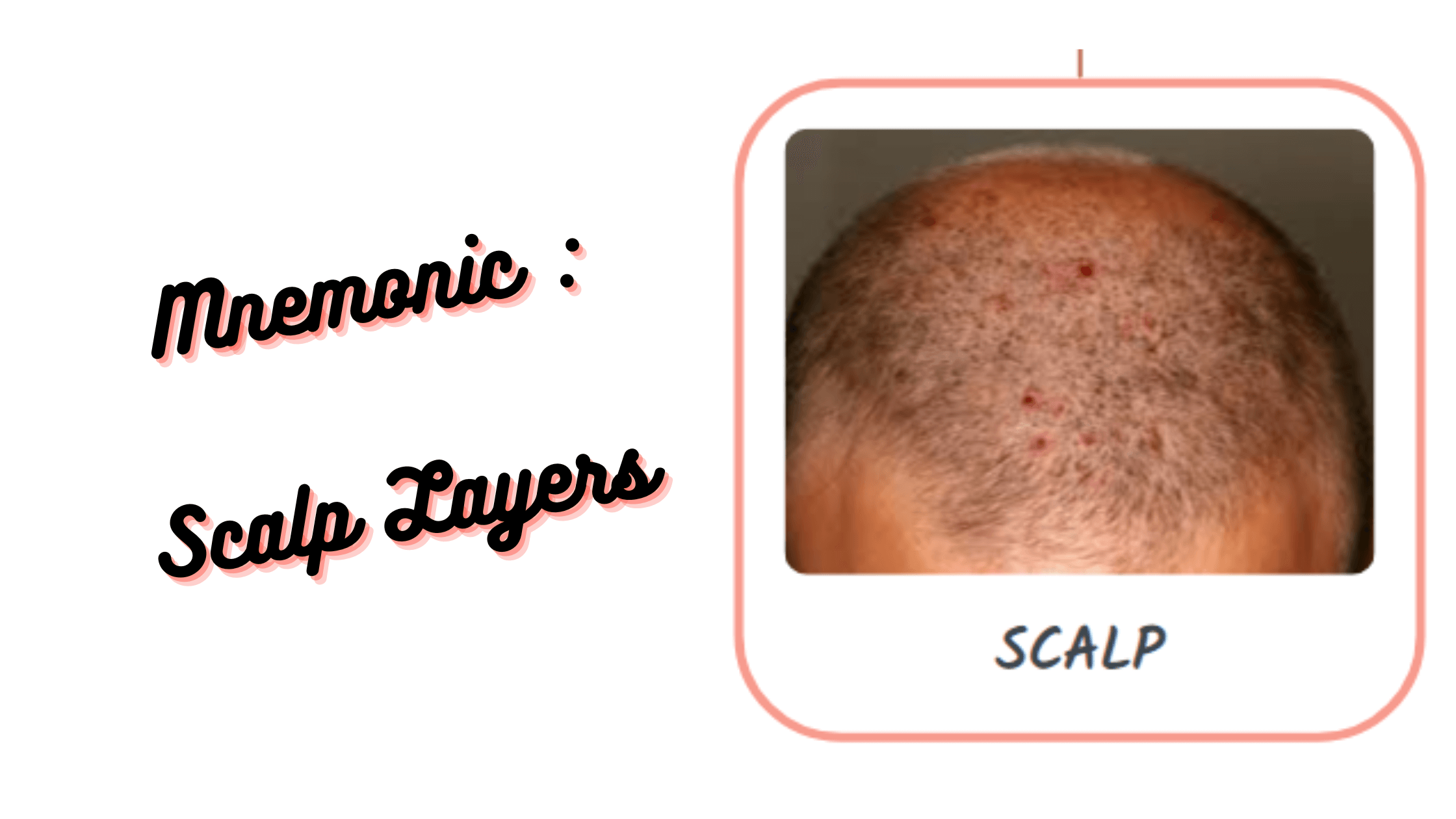 You are currently viewing Mnemonic :  Scalp layers