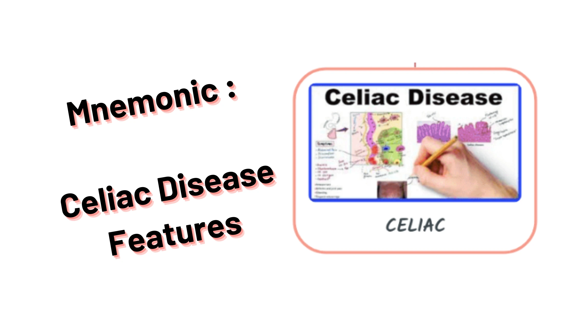 Medical & Nursing Mnemonic _ Celiac Sprue Features