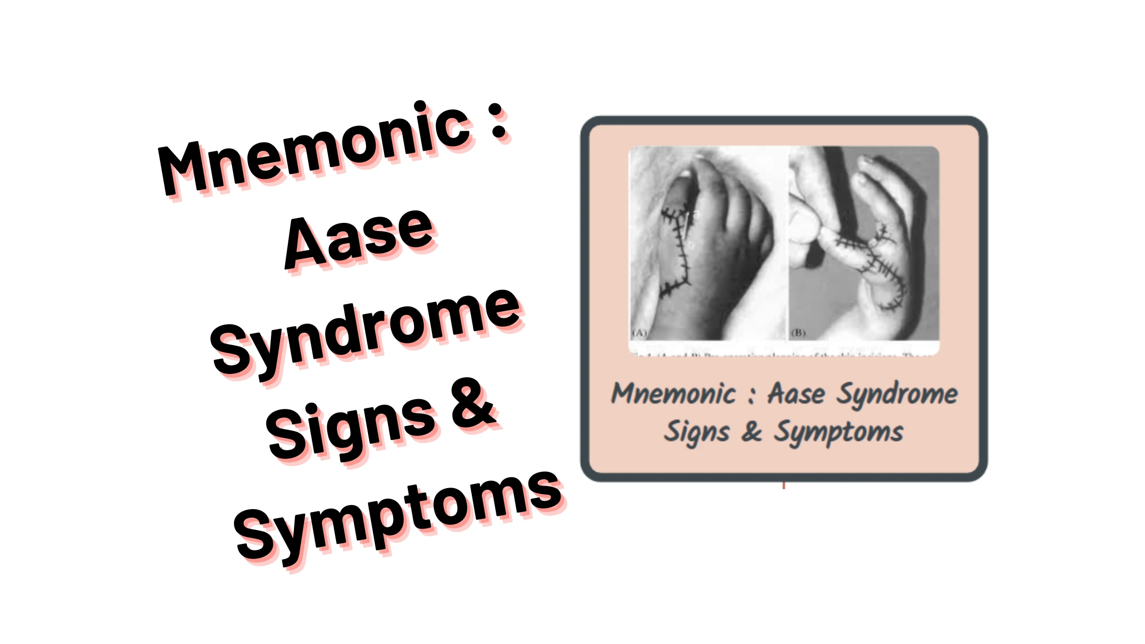 You are currently viewing [Very Cool] Mnemonic : Aase Syndrome Signs & Symptoms