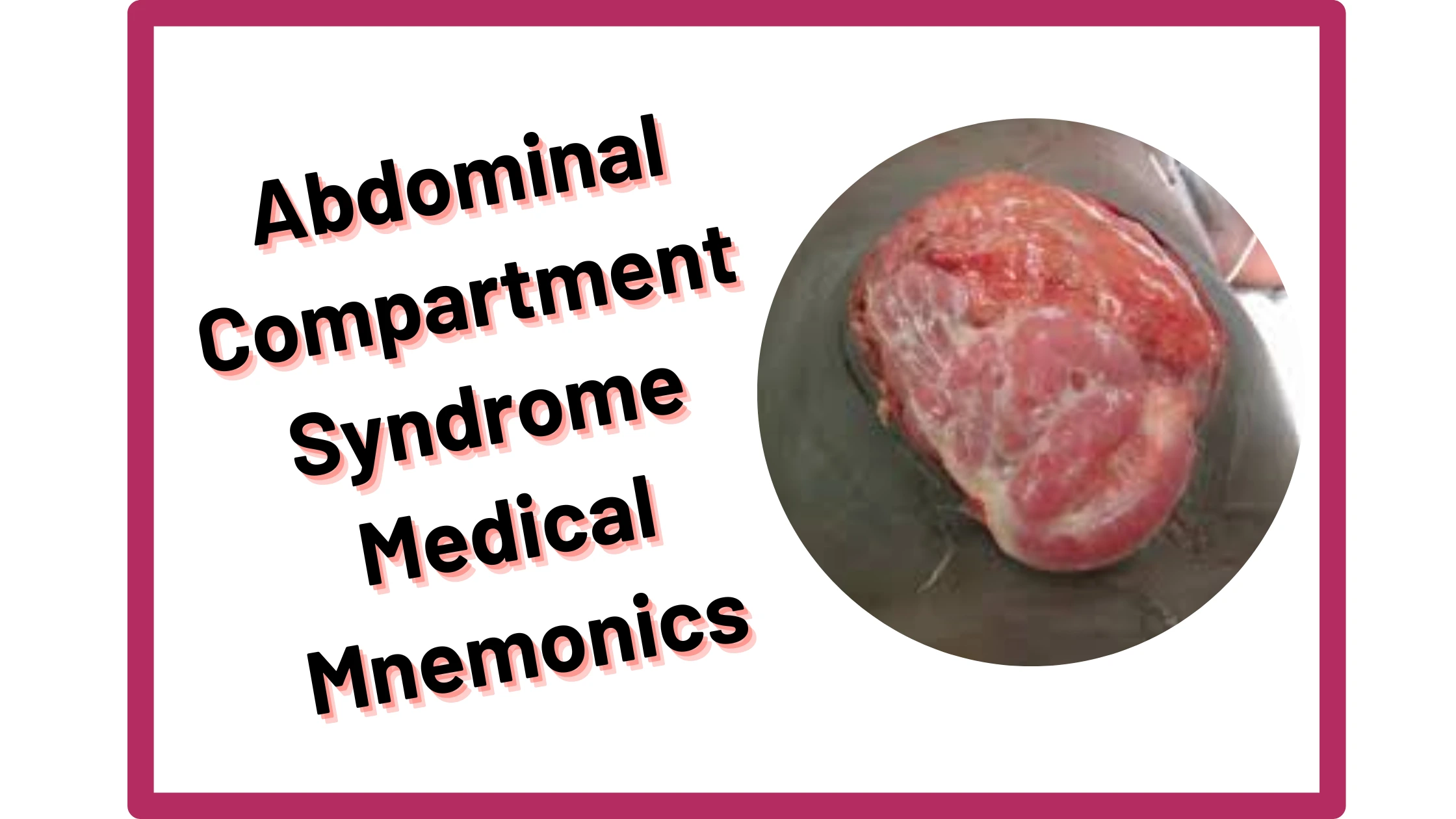 You are currently viewing [Very Cool] Mnemonic : Abdominal Compartment Syndrome Signs & Symptoms