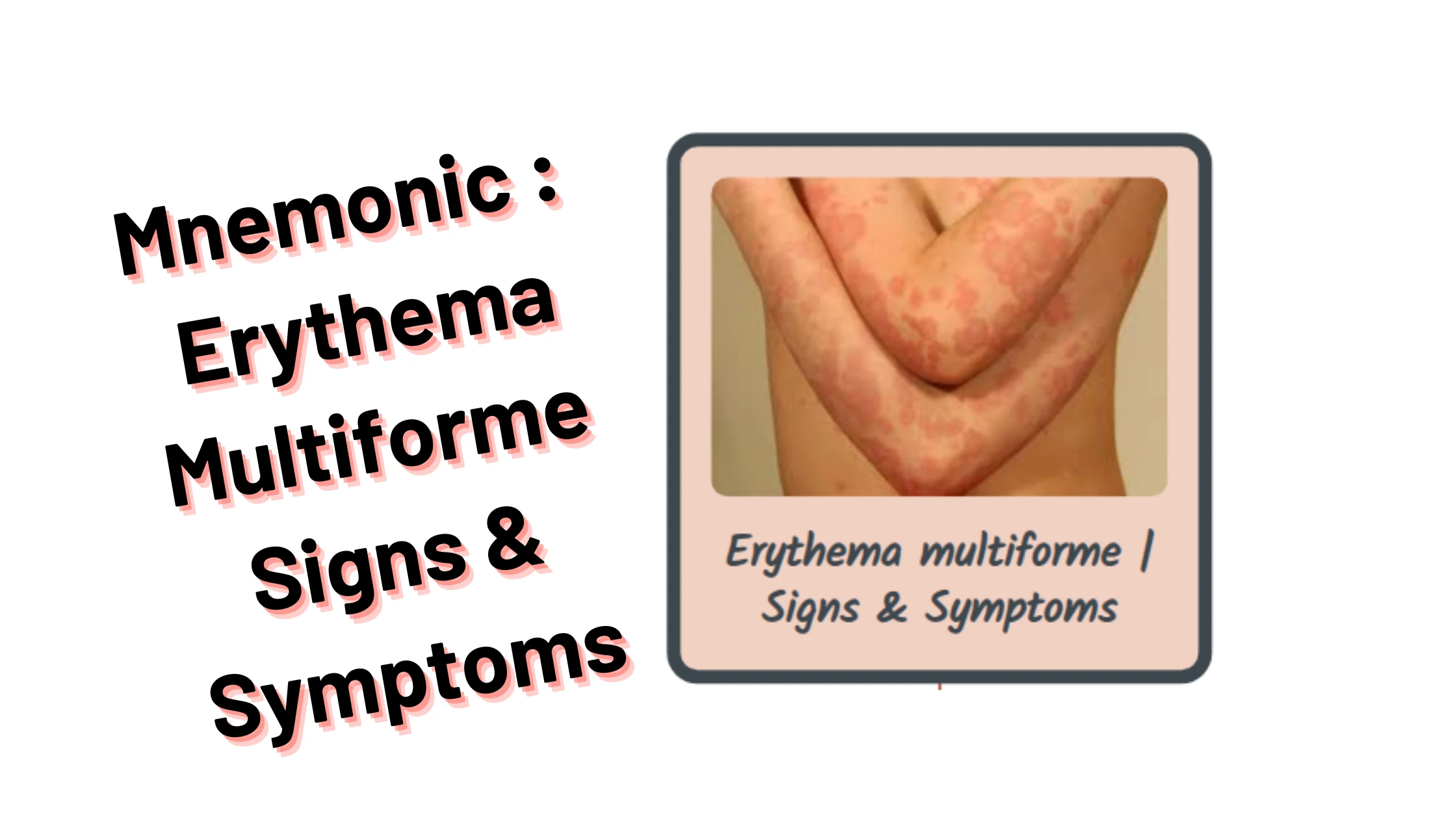 You are currently viewing [Very Cool] Mnemonic : Erythema Multiforme Signs & Symptoms