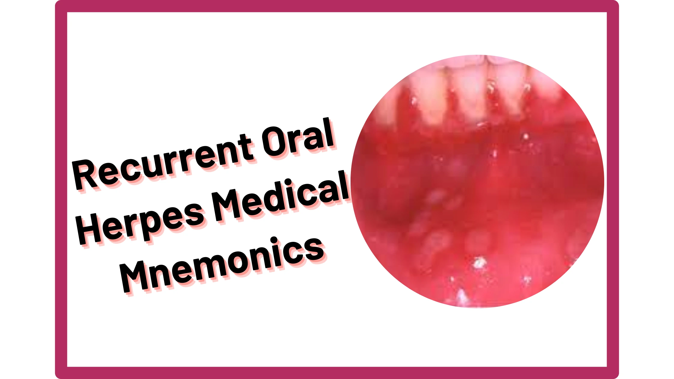 You are currently viewing [Very Cool] Mnemonic : Recurrent oral herpes Signs & Symptoms