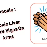 Mnemonic _ Chronic Liver Failure Signs On Arms