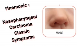 Mnemonic :Nasopharyngeal Carcinoma Classic Symptoms