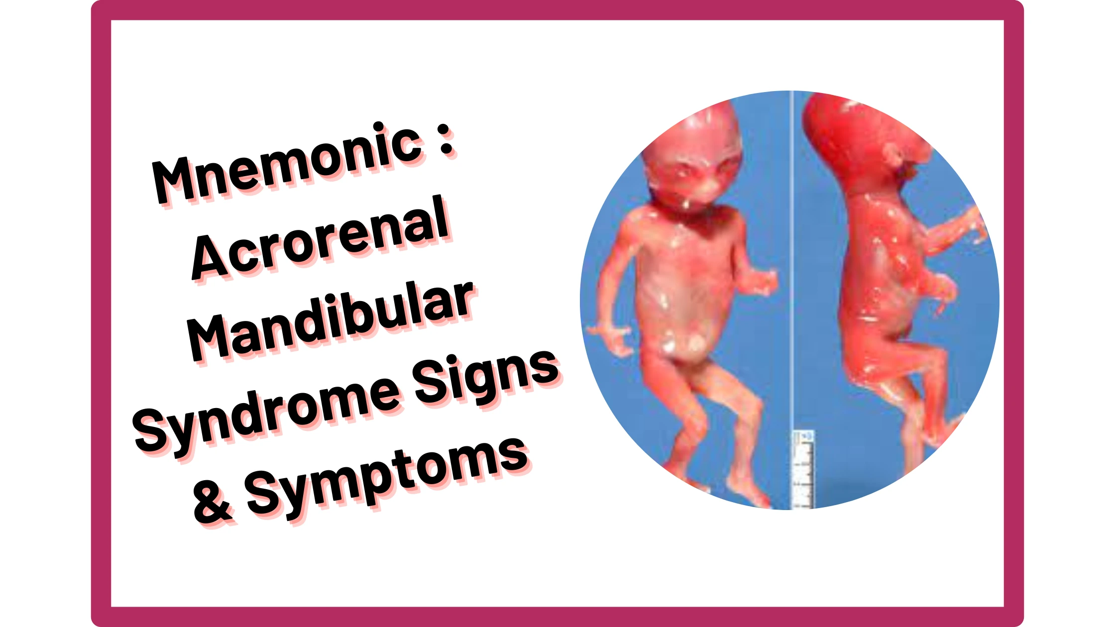 You are currently viewing [Very Cool] Mnemonic : Acrorenal Mandibular Syndrome Signs & Symptoms