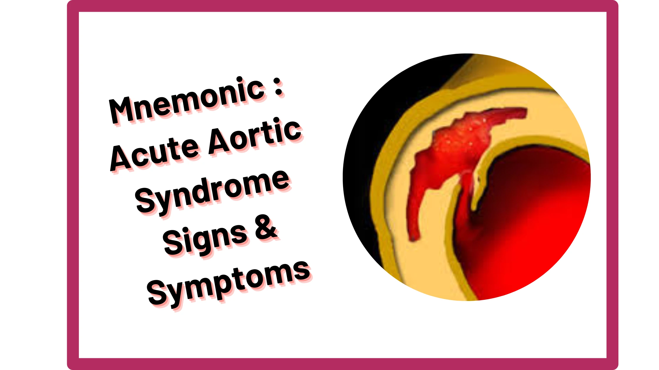 You are currently viewing [Very Cool] Mnemonic : Acute Aortic Syndrome Signs & Symptoms