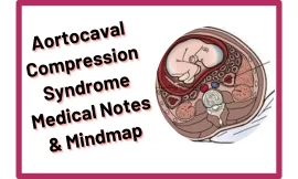 Aortocaval Compression Syndrome :‎ Medical Notes & Mindmap