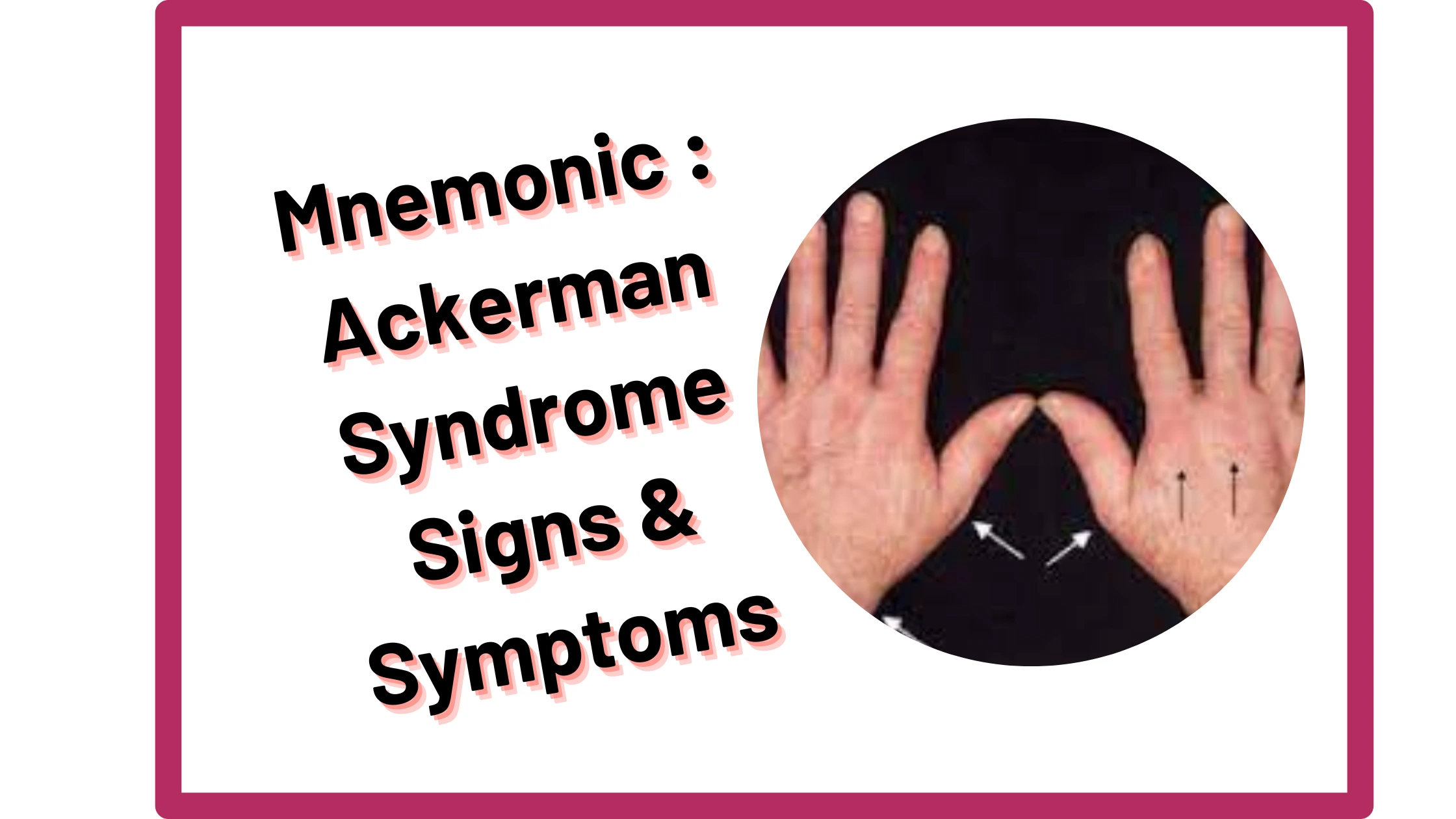 You are currently viewing [Very Cool] Mnemonic : Ackerman Syndrome Signs & Symptoms