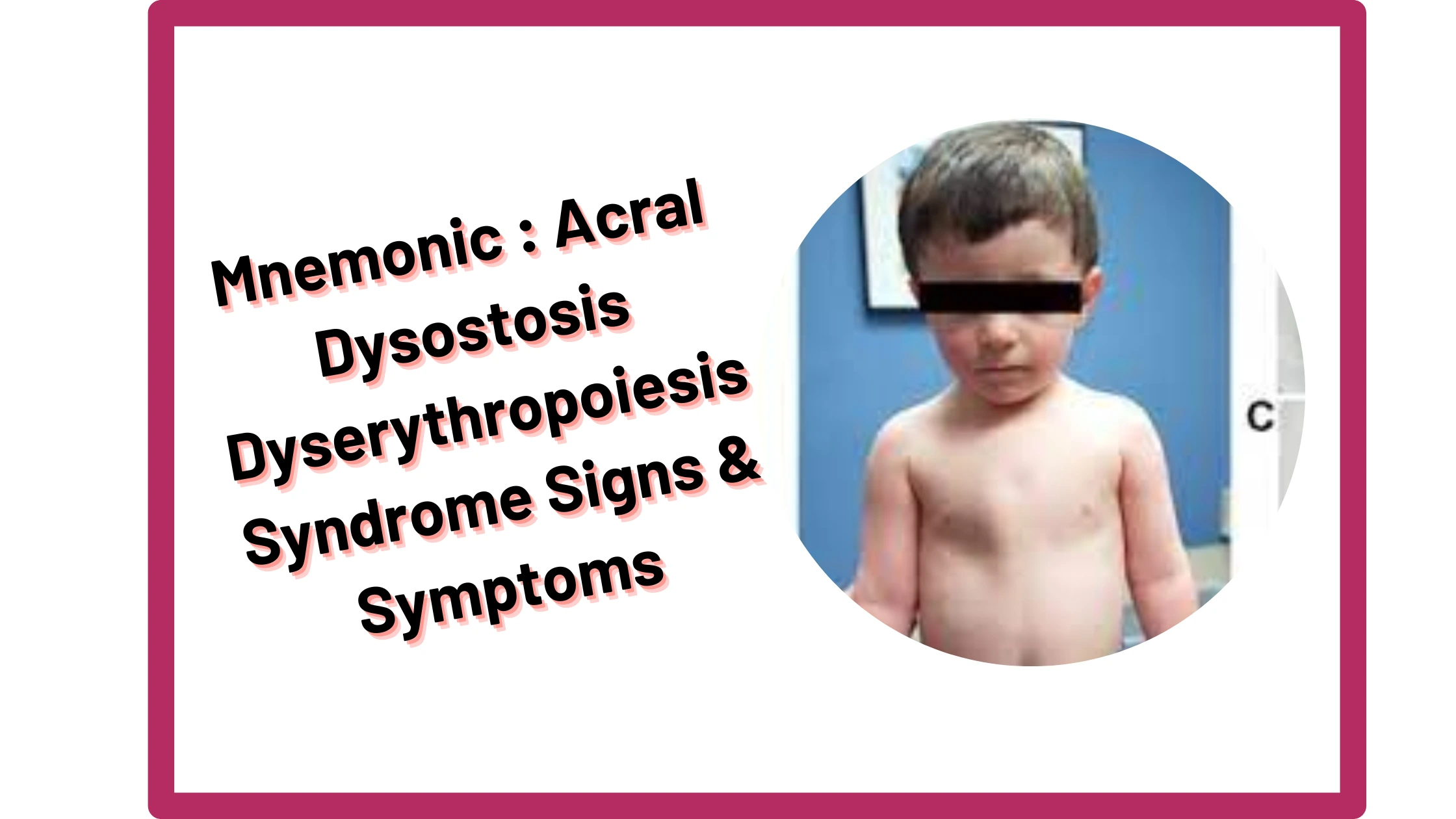 You are currently viewing [Very Cool] Mnemonic : Acral Dysostosis Dyserythropoiesis Syndrome Signs & Symptoms
