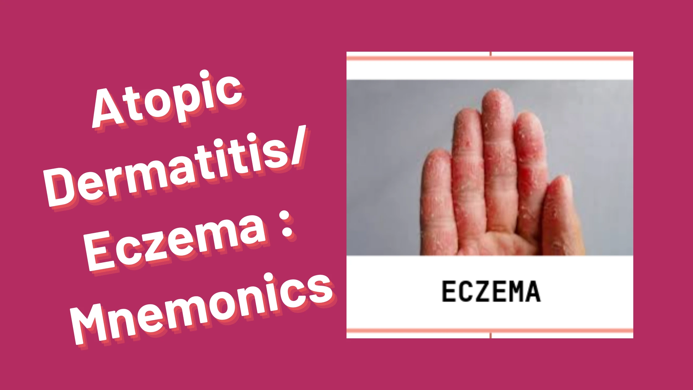 You are currently viewing Atopic Dermatitis/Eczema : Mnemonics [Remember Easily]
