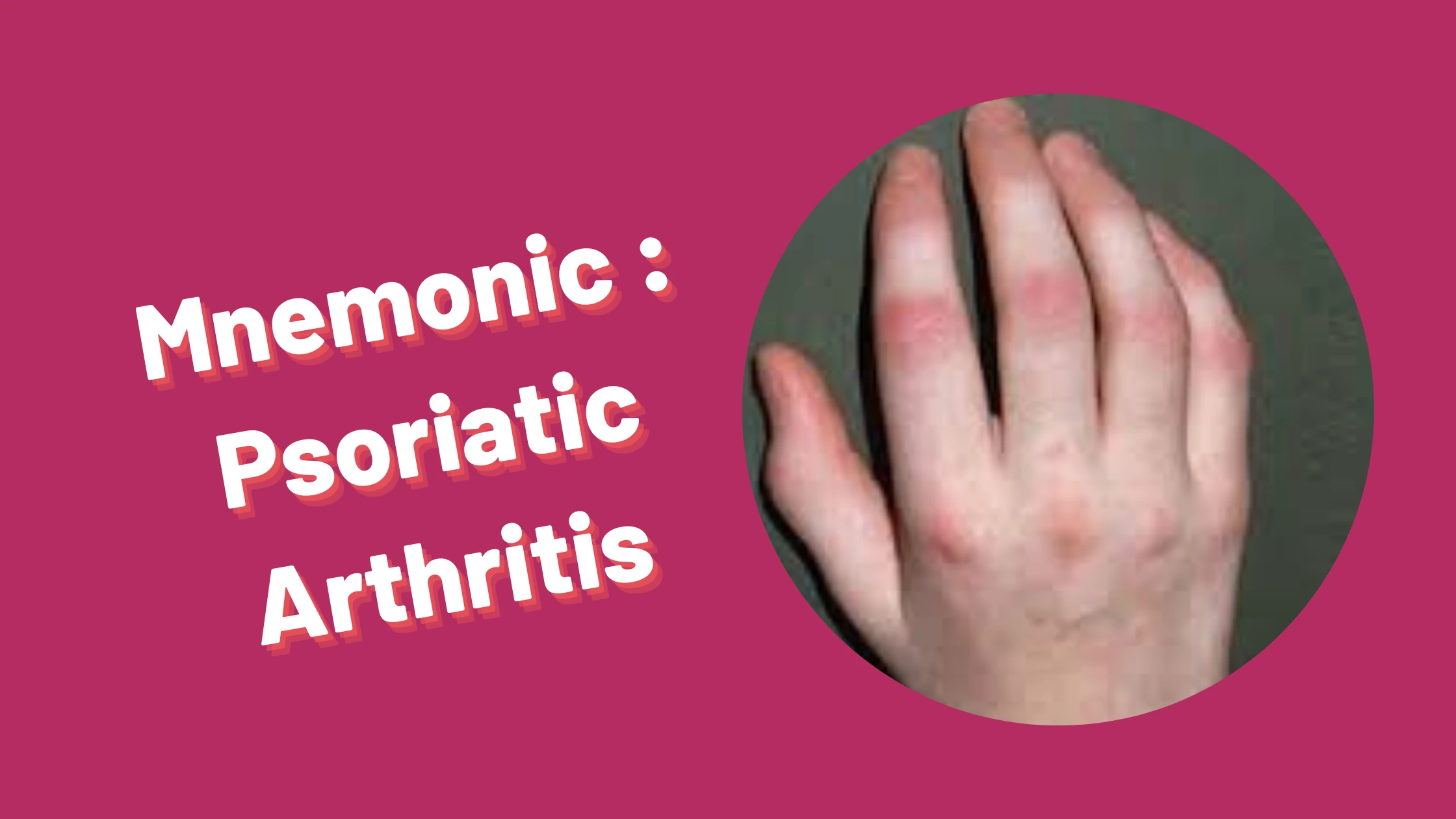 You are currently viewing [Very Cool] Mnemonic : Psoriatic arthritis