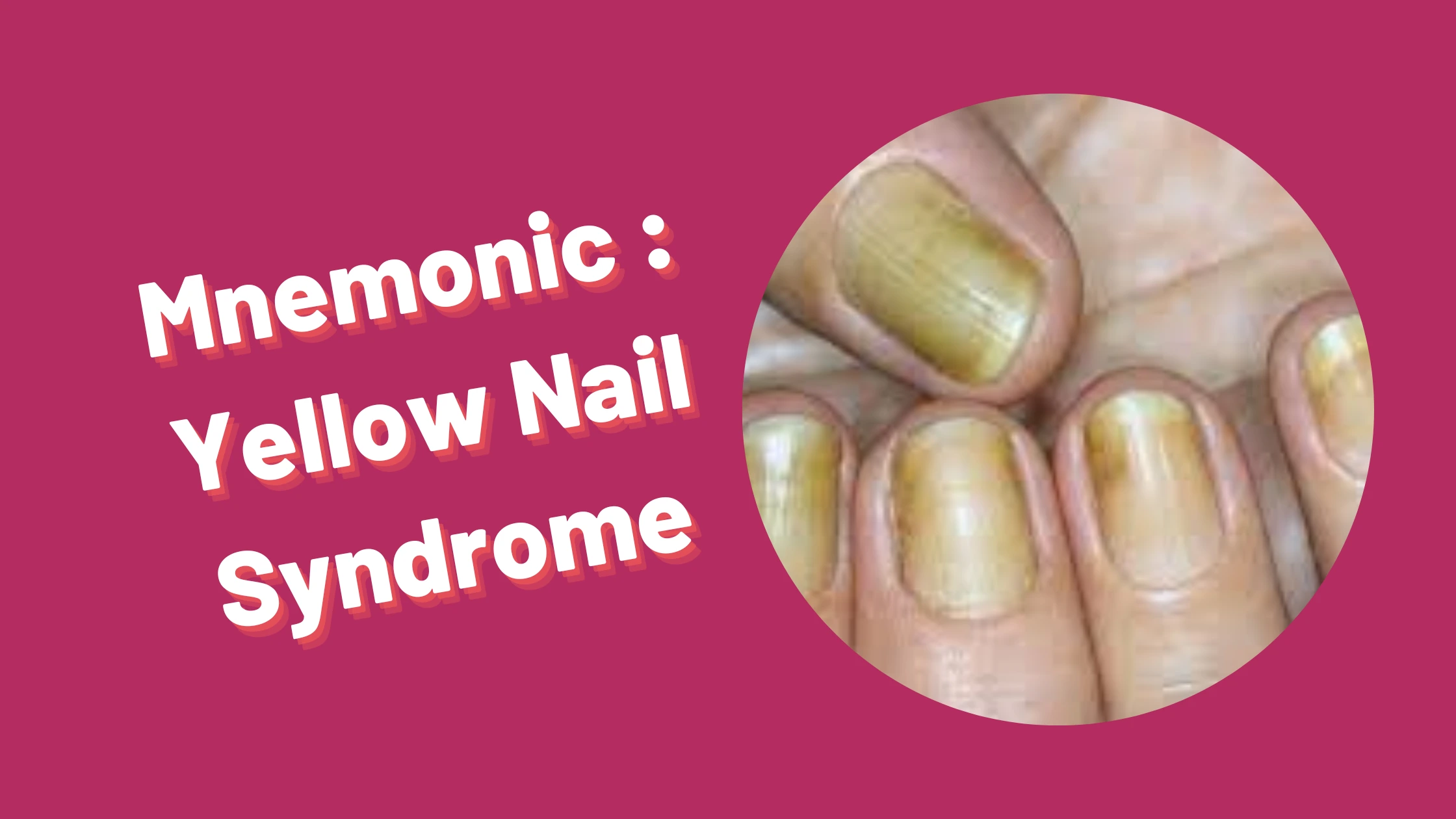 You are currently viewing [Very Cool] Mnemonic : Yellow Nail Syndrome
