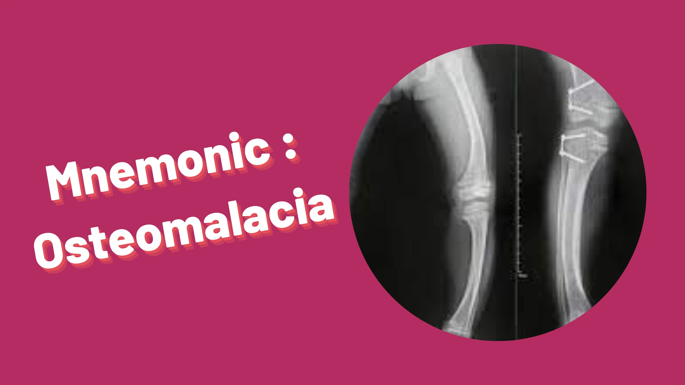 You are currently viewing [Very Cool] Mnemonic : Osteomalacia