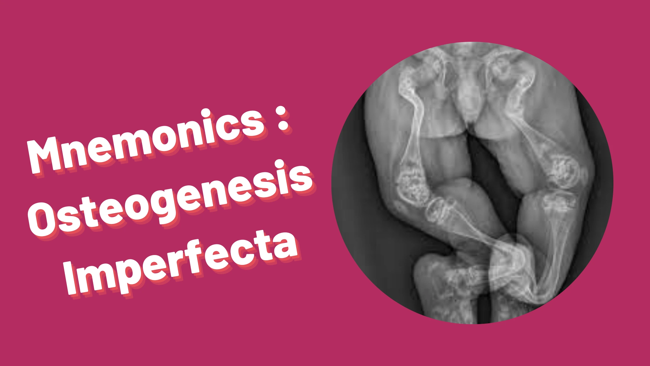 You are currently viewing [Very Cool] Mnemonic : Osteogenesis Imperfecta