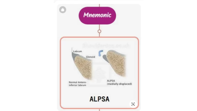 Read more about the article ALPSA Lesion : Mnemonics [NEVER FORGET AGAIN]