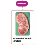 Read more about the article Armanni-Ebstein Lesion : Mnemonics [NEVER FORGET AGAIN]