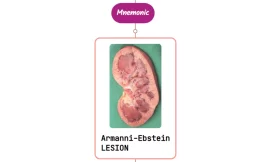 Armanni-Ebstein Lesion : Mnemonics [NEVER FORGET AGAIN]