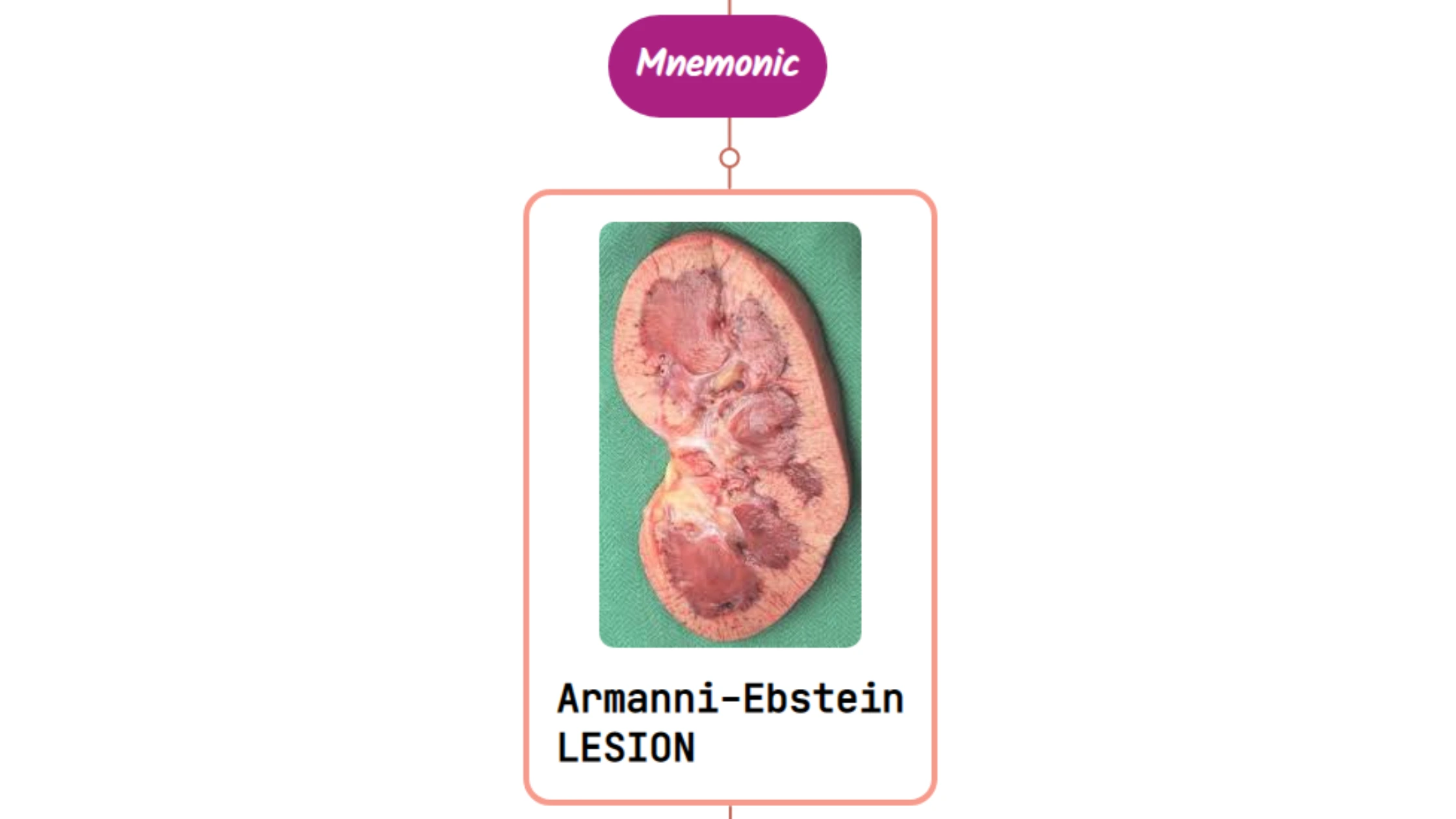 You are currently viewing Armanni-Ebstein Lesion : Mnemonics [NEVER FORGET AGAIN]