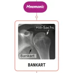 Read more about the article Bankart Lesion : Mnemonics [NEVER FORGET AGAIN]