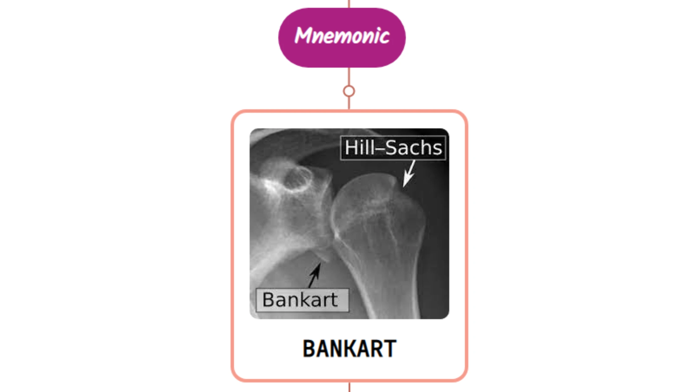 You are currently viewing Bankart Lesion : Mnemonics [NEVER FORGET AGAIN]