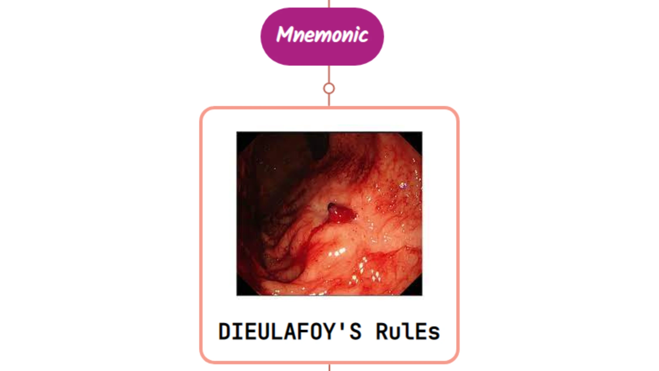 You are currently viewing Dieulafoy’s Lesion : Mnemonics [NEVER FORGET AGAIN]