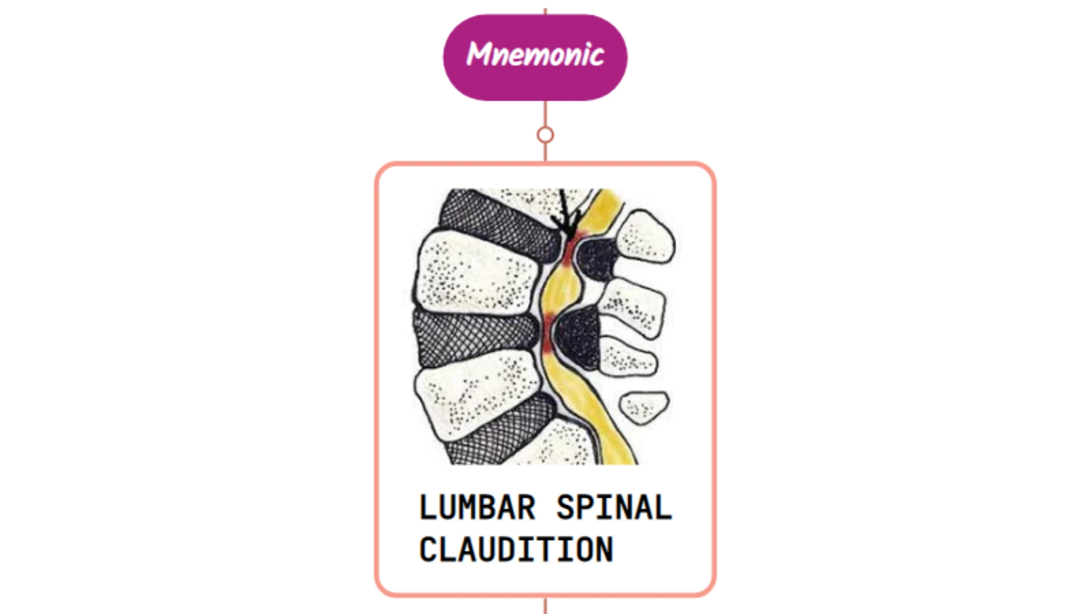 You are currently viewing Lumbar Spinal Stenosis : Mnemonics