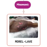 Read more about the article Morel-Lavallee Lesion : Mnemonics [NEVER FORGET AGAIN]