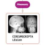 Read more about the article Osteoporosis Circumscripta Lesion Mnemonics [NEVER FORGET AGAIN]