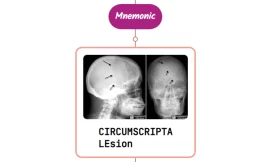 Osteoporosis Circumscripta Lesion Mnemonics [NEVER FORGET AGAIN]