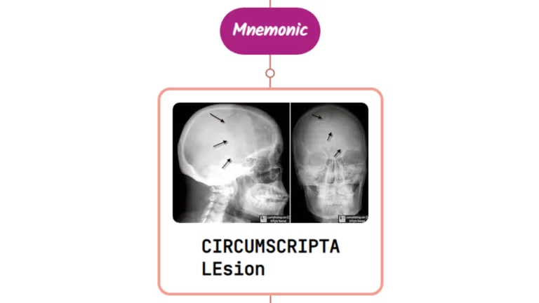 Read more about the article Osteoporosis Circumscripta Lesion Mnemonics [NEVER FORGET AGAIN]