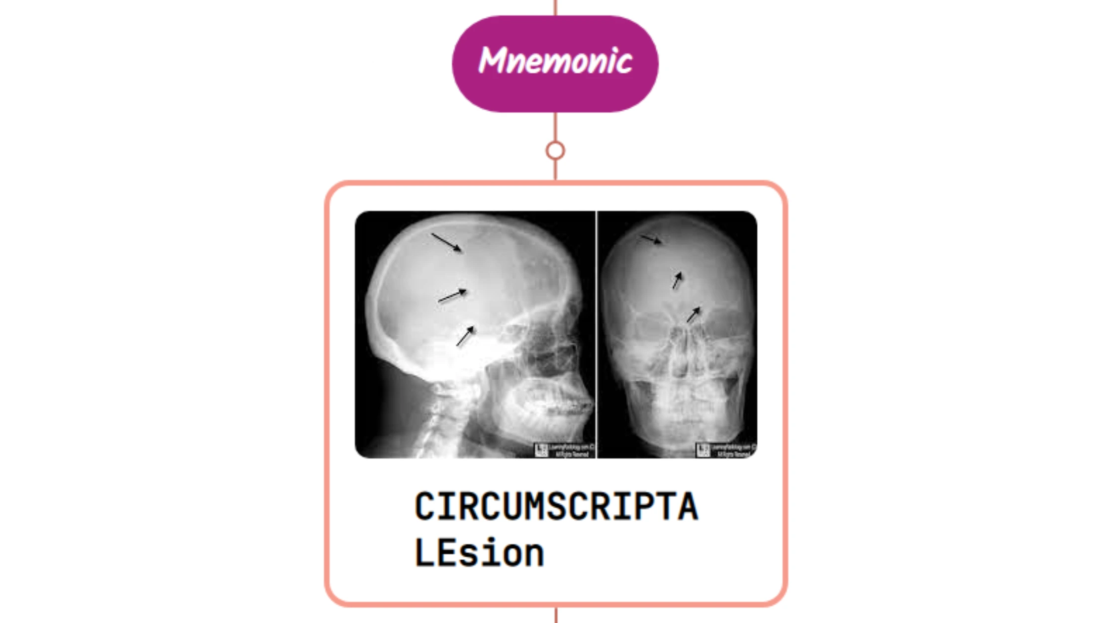 You are currently viewing Osteoporosis Circumscripta Lesion Mnemonics [NEVER FORGET AGAIN]