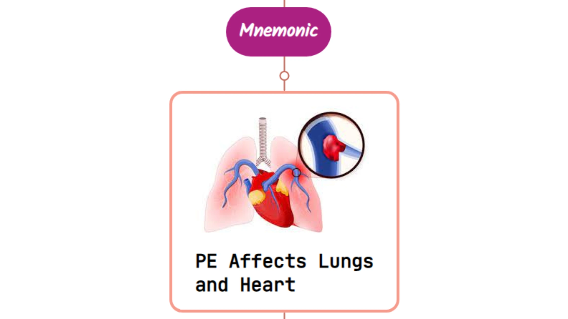 You are currently viewing Pulmonary Embolism In Chest Pain Mnemonic