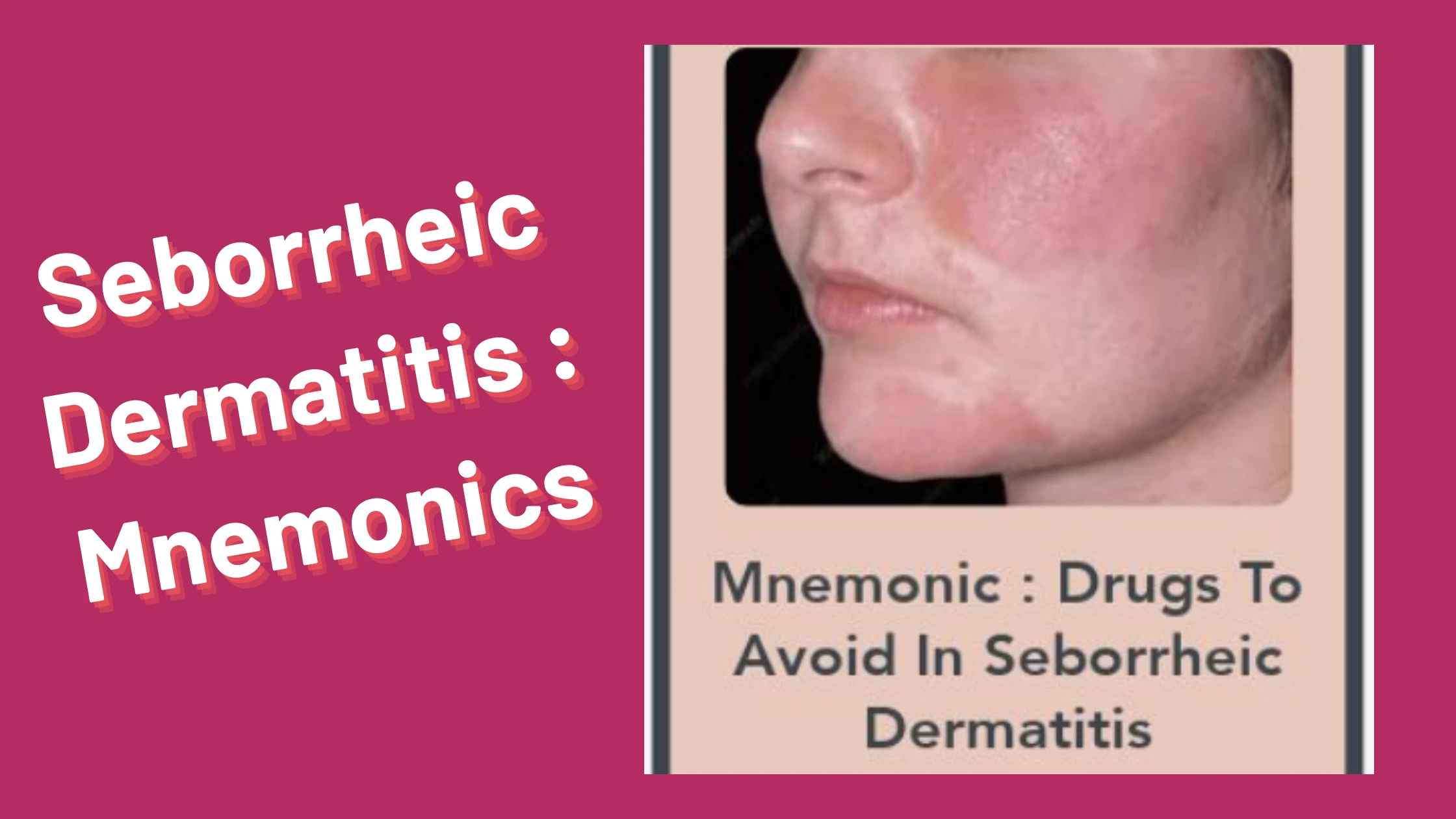 You are currently viewing Seborrheic Dermatitis : Mnemonics [Remember Easily]