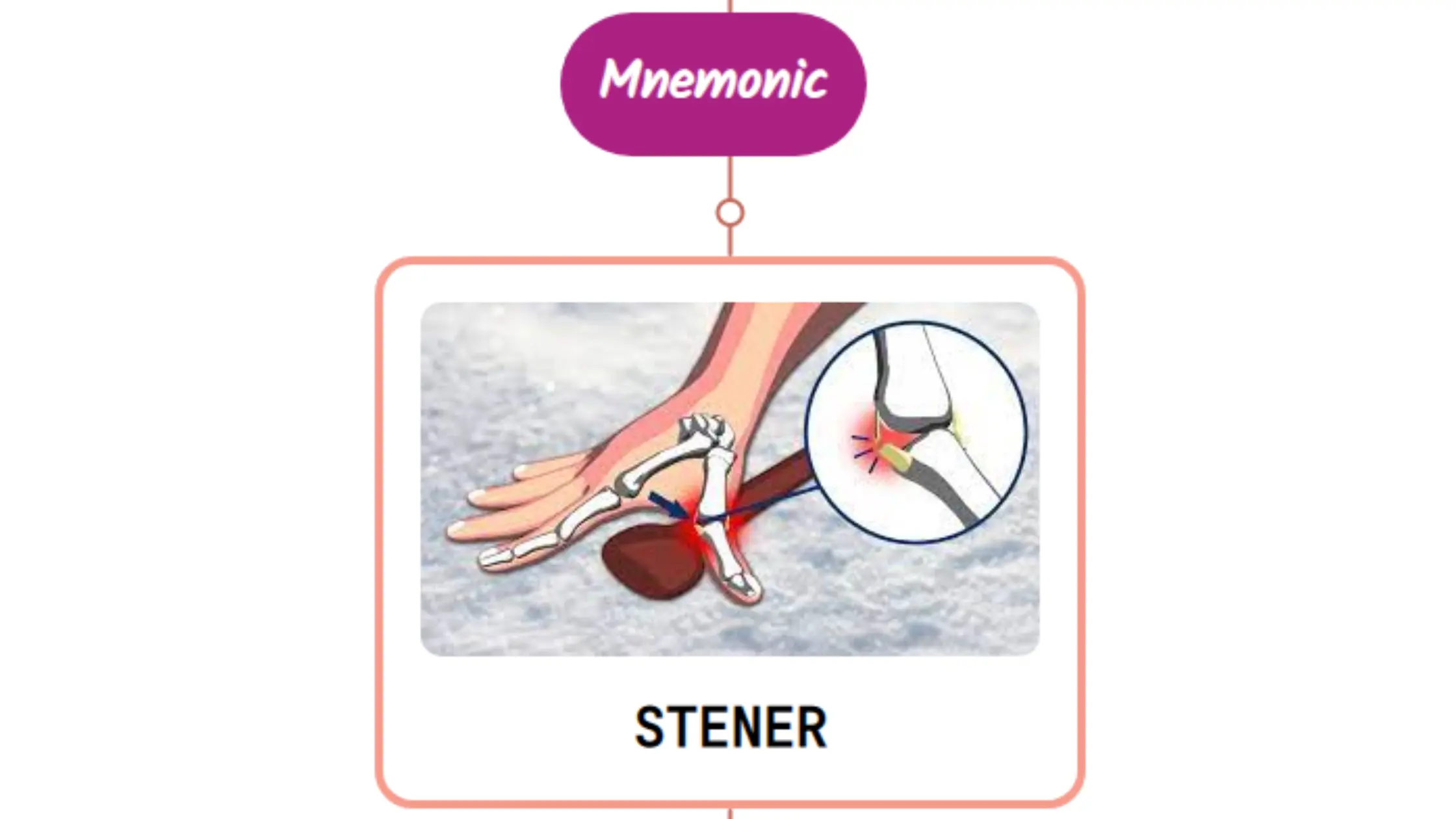 You are currently viewing Stener Lesion : Mnemonics [NEVER FORGET AGAIN]