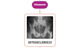 Vertebral Fractures Due To Osteoporosis and Osteosclerosis : Mnemonics