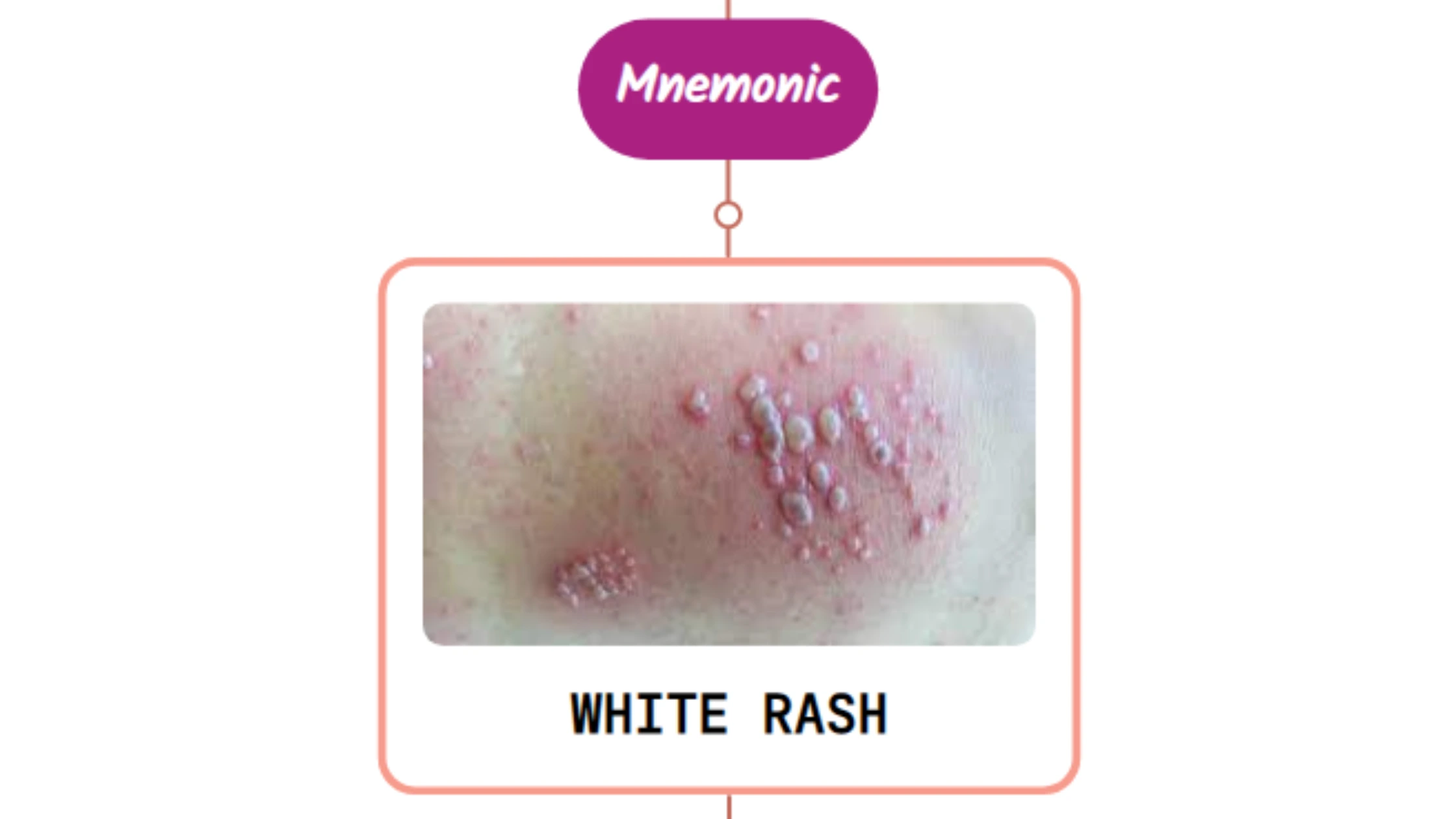 You are currently viewing African Trypanosomiasis Rash Mnemonic : [NEVER FORGET AGAIN]