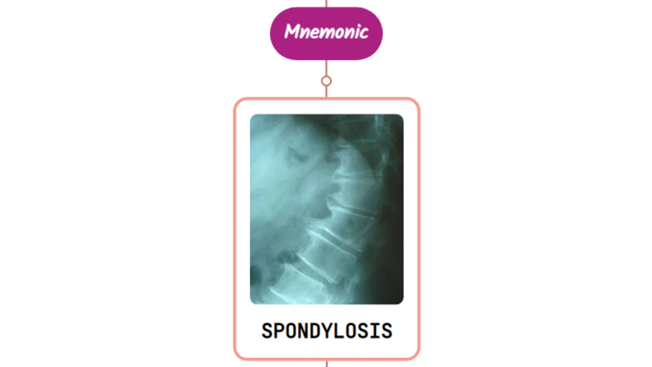 You are currently viewing Cervical Spondylosis : Mnemonic