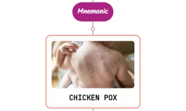 Chicken Pox (Varicella) Rash : Mnemonic
