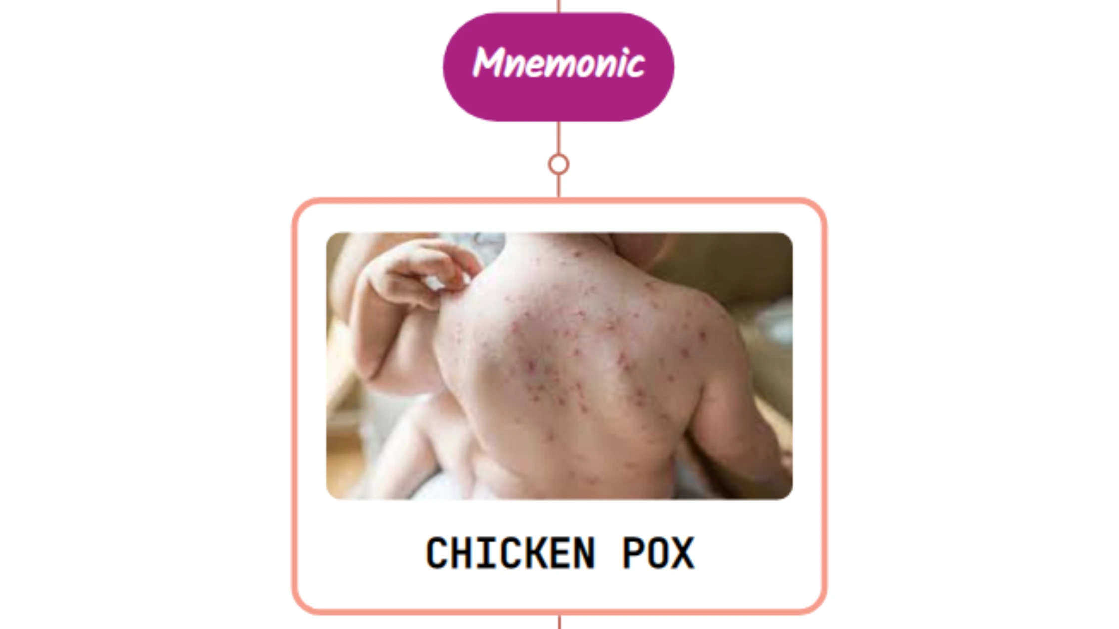 You are currently viewing Chicken Pox (Varicella) Rash : Mnemonic