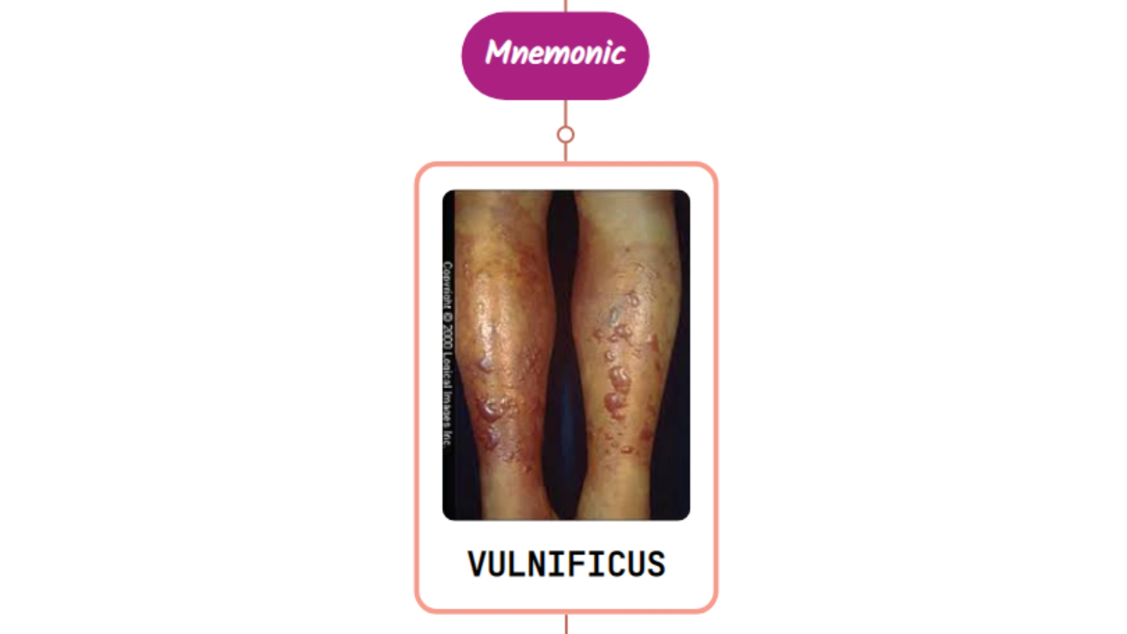 You are currently viewing Disseminated Vibrio Vulnificus Infection Rash : Mnemonic