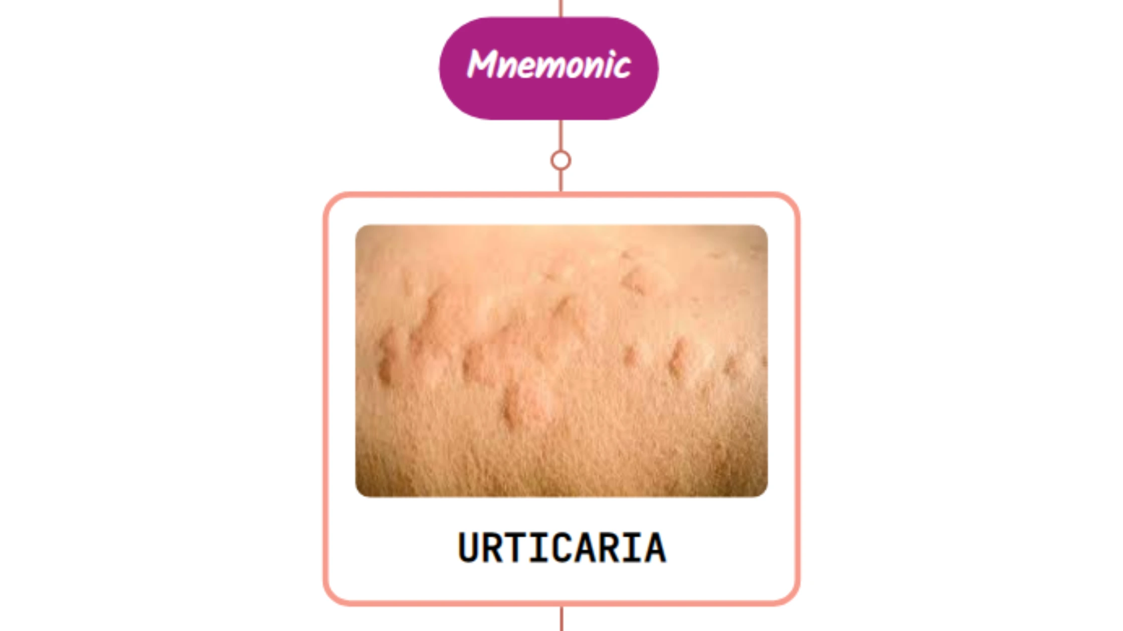 You are currently viewing Infectious Mononucleosis Rash : Mnemonic