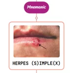 Read more about the article Primary Herpes Simplex Virus (HSV) Infection Rash : Mnemonic