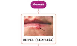 Primary Herpes Simplex Virus (HSV) Infection Rash : Mnemonic