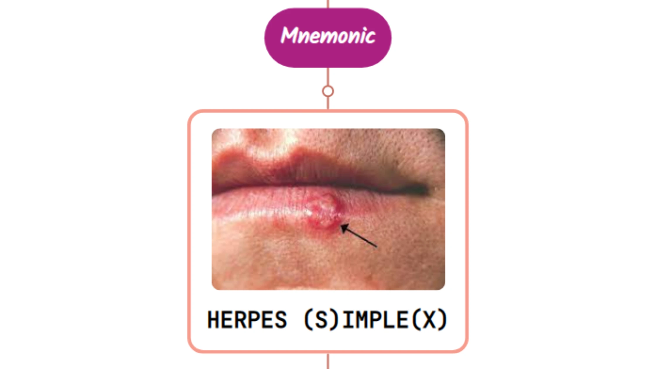 You are currently viewing Primary Herpes Simplex Virus (HSV) Infection Rash : Mnemonic