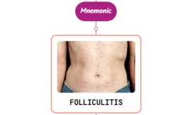 Pseudomonas (Hot Tub) Folliculitis Rash : Mnemonic