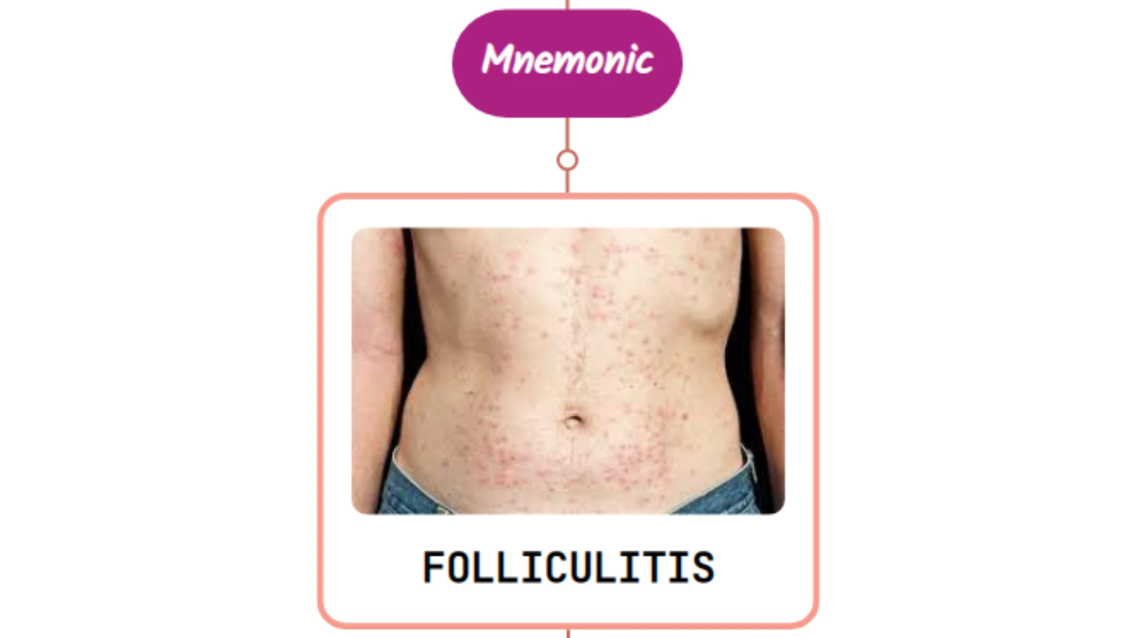 You are currently viewing Pseudomonas (Hot Tub) Folliculitis Rash : Mnemonic