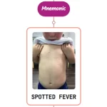 Read more about the article Rocky Mountain Spotted Fever Rash Mnemonic : [NEVER FORGET AGAIN]