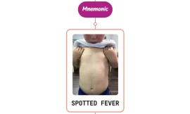 Rocky Mountain Spotted Fever Rash Mnemonic : [NEVER FORGET AGAIN]