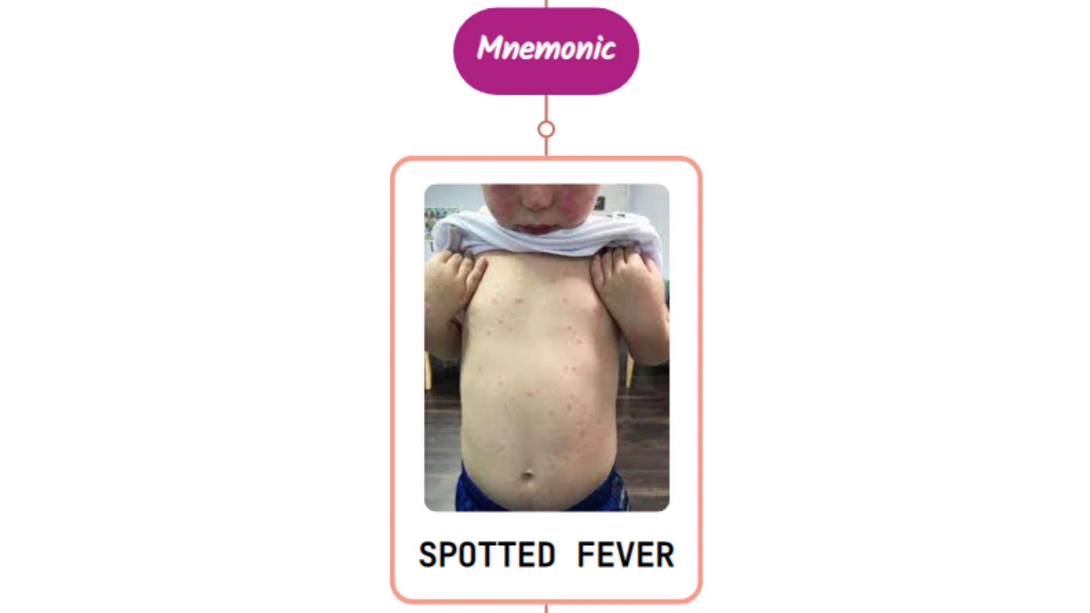 You are currently viewing Rocky Mountain Spotted Fever Rash Mnemonic : [NEVER FORGET AGAIN]