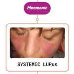 Read more about the article Systemic Lupus Erythematosus Fever Rash: Mnemonic [NEVER FORGET AGAIN]